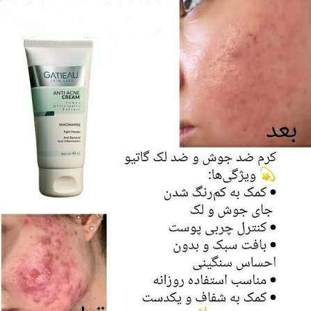کرم ژل آنتی آکنه گاتیو | ضد جوش و ضد لک ۴۰ میلی لیتر